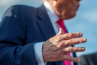 Больные-вены-и-простой-синяк?-Врач-Воробьев-поставил-Трампу-другой-диагноз