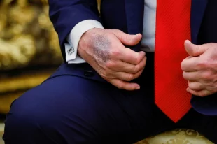 Препараты и травмы? Врач Воробьев предположил, отчего синяк на руке Трампа